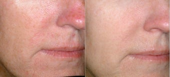 Photorejuvenation before 386574