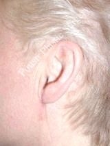 Earlobe Repair Surgery after 612308