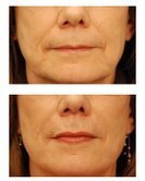 Perlane and Juvederm Injections for wrinkles and lip augmentation before 53753