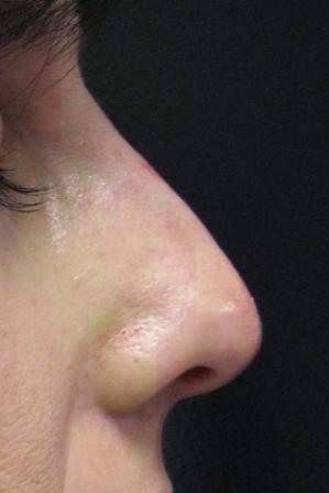 Nasal Tip created using Radiesse after 152209
