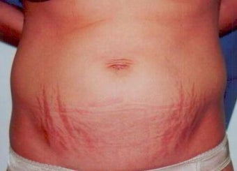 Laser Skin Resurfacing with Smartxide DOT Therapy before 238267