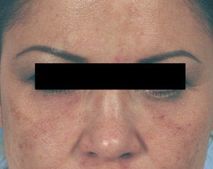 Restylane for eye bags after 199404