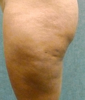 Cellulaze before 582371