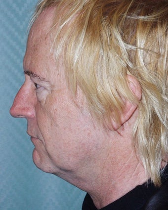 Facelift, brow and eyelid lifts before 118267
