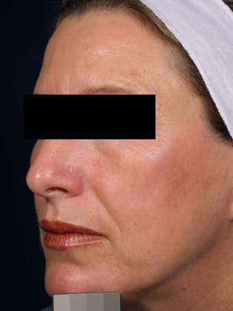 IPL treatments after 135041