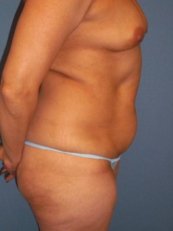 Tummy Tuck before 340068