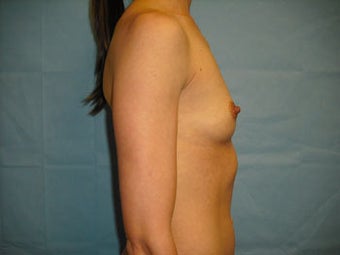 Breast Implants before 137926