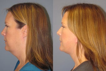 Lite Lift, liposuction of the neck, blue peel after 523484