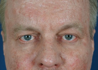 Man in 50's seek non-surgical facial rejuvention before 634493