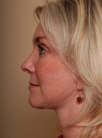 Refresher Facelift w/Neck Plication, Browllift, Fat Injections to Cheeks after 252876