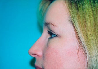 Eyelid Surgery (Blepharoplasty) after 265351