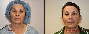 Fat transfer to face before 253849