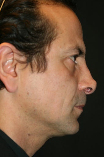 Male Rhinoplasty Revision 428237