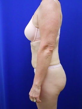 Zerona 419304