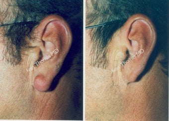 Earlobe Surgery before 243322