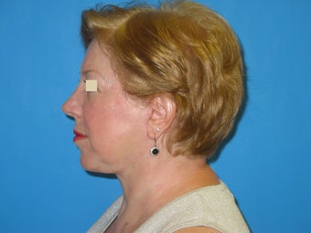 Facelift after 147385