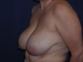 Reduction Mammaplasty before 141194