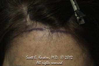AccuGraft Hair Transplant before 589692