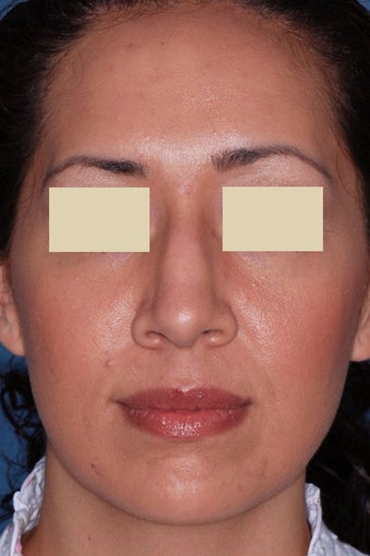 Rhinoplasty before 91600