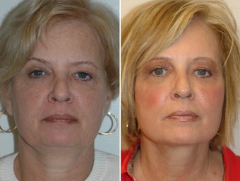 Facelift and upper and lower blepharoplasty. before 228963