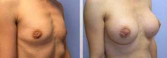 Breast Augmentation before 256395