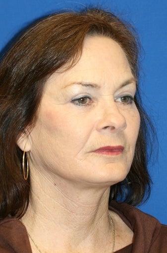 6 months post op: Facelift, Fat Transfer, Upper Bleph., Skin Pinch, & Chemical Peel 424205