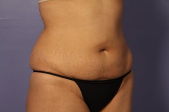Liposuction after 588022