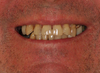Full Porcelain Crowns before 145681