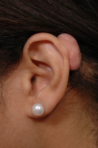Keloid Removal before 358913