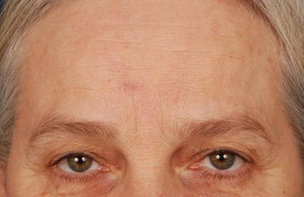 Mole Removal after 258477