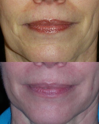 HA filler to lower face before 406154