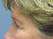 Brow Lift 541493