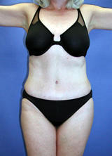 Abdominoplasty Surgery after 131919