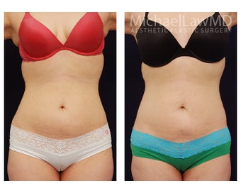 Liposuction before 391813