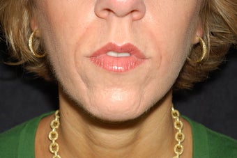 Nasal labial folds treatment with Evolence before 102459