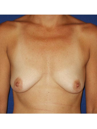 Bilateral periareolar mastopexy augmentation with placement of 421cc smooth silicone breast implants before 249998