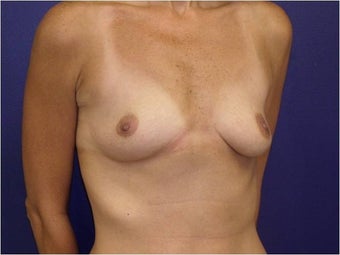 Breast Augmentation before 427306