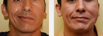 Facial Paralysis and Reconstruction before 346224