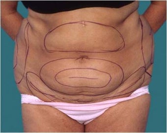 Liposuction before 590650