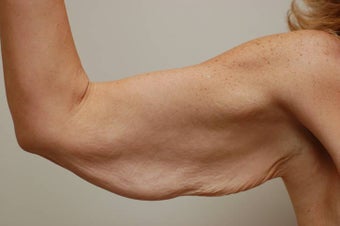arm tuck before 258899