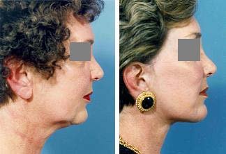 Facelift before 643030