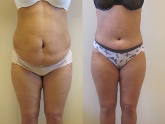 Abdominoplasty before 220767