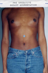 Transgender Surgery before 131854