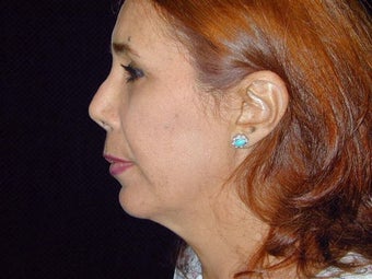 Face lift, brow lift, eyelid lift before 251755