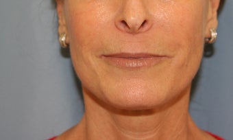 Juvederm injection after 343529