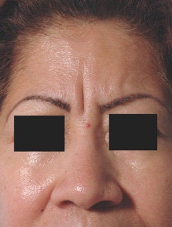 Botox for frown line (glabella) before 91302