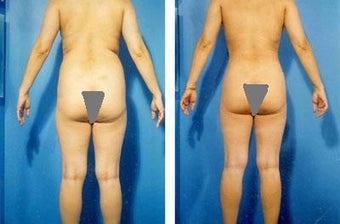 Liposuction before 636162