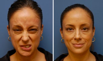 Botox for Synkinesis, Bell's Palsy, Facial Paralysis before 346230