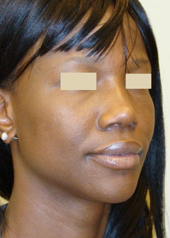 African American Rhinoplasty after 104226