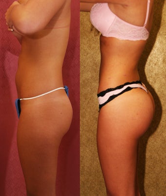 Brazilian Buttock Augmentation with microfat grafting after 453361